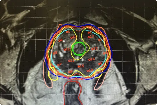 Oncología de precision - Braquiterapia de Alta Tasa Guiada por Imagen
