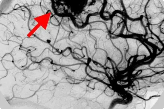 radioterapia funcional - Malformaciones arteriovenosas (MAV)